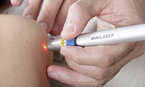 Pembuangan papilloma dengan laser