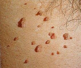 Human papillomavirus pada kulit