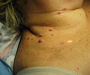 Human papillomavirus pada leher