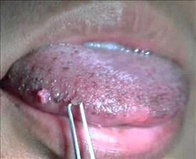 papillomavirus manusia pada lidah
