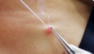 Pembuangan papilloma pada badan dengan laser